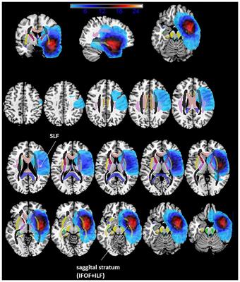 Risk Assessment by Pre-surgical Tractography in Left Hemisphere Low-Grade Gliomas